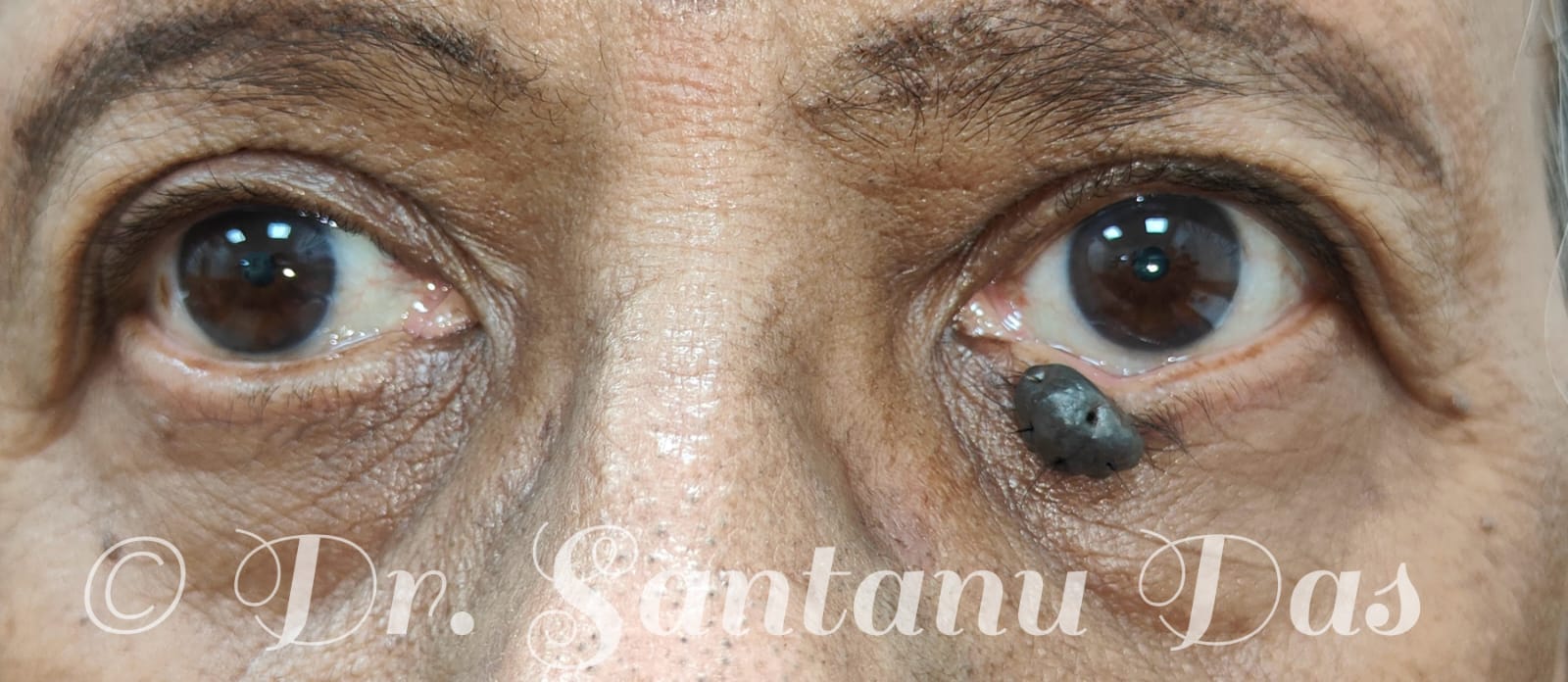 Lower eyelid naevus